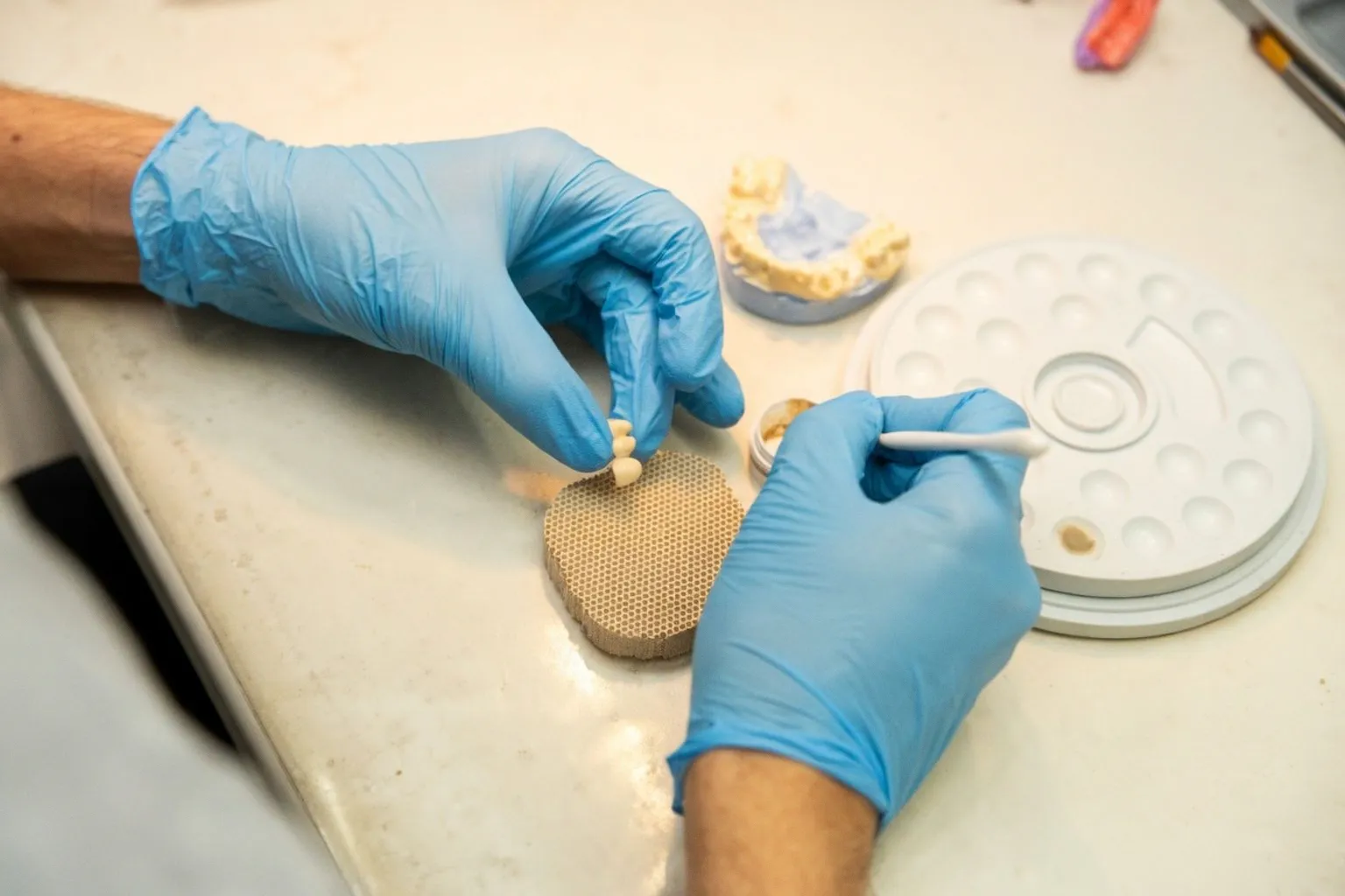 Periimplantitis vorbeugen: So sichern Sie den langfristigen Erfolg Ihrer Zahnimplantate